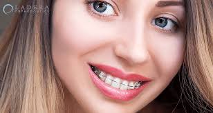 Clear aligners are more expensive than metal dental braces, but its cost is almost the same as ceramic dental braces and lower than that of lingual braces, which are the alternatives. Ceramic Clear Braces Or Metal Braces What Are The Differences