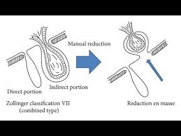 Image result for Hernia Reduction