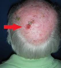 But sometimes they may grow quickly. Skin Cancer On Scalp Causes Types Symptoms Treatment Pictures Prognosis Healthmd