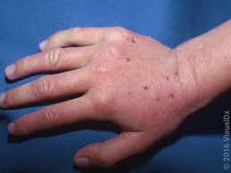 Image result for skin rash similar to scabies