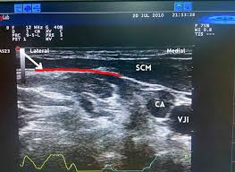 Image result for Superior Trunk Block