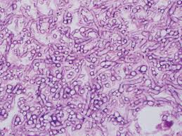 It is more common in immunosuppressed humans and in those under prolonged antibiotic treatment. Pulmonary Mucormycosis Risk Factors Radiologic Findings And Pathologic Correlation Radiographics
