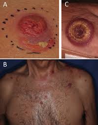 Image result for Nodule