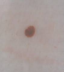 Unusual moles, sores, lumps, blemishes, markings, or changes in the way an area of the skin looks or feels may be a sign of melanoma or another type of skin cancer, or a warning that it might occur. Melanoma Symptoms Treatment And Prevention Live Science