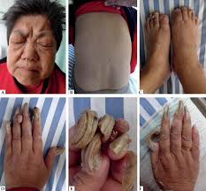 Image result for Onychogryphosis feet