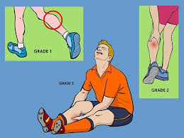How To Treat A Torn Calf Muscle Torn Calf Muscle Torn Calf Muscle Treatment Pulled Calf Muscle Treatment