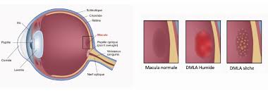 Liste(s) de symptome(s) à titre informatif uniquement, vous ne pouvez pas et ne devez pas établir un diagnostic avec ces informations. Dmla Besancon Dmla Seche Et Humide Injections Intra Vitreennes 25