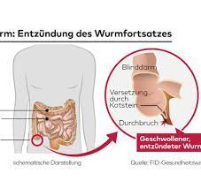 Examples from the pons dictionary (editorially verified) jdm den blinddarm entfernen. Appendix Ist Der Blinddarm Wichtig Oder Kann Er Weg Welt