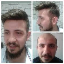 Isparta Protez Sac