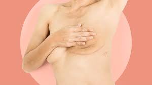 Image result for Mastectomy