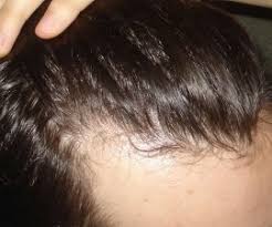 A receding hairline means your hair is starting to fall out from the front and around your temples. How To Stop Receding Hairline For Black Men