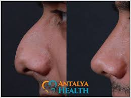 See rhinoplasty clinics, compare prices and find rhinoplasty surgeons. 10 Golden Rules After Rhinoplasty Nose Job In Turkey