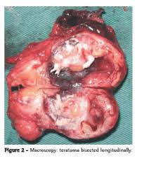 Mature cystic teratomas are encapsulated tumors with mature tissue or organ components. Jornal Brasileiro De Pneumologia Teratoma De Mediastino Com Degeneracao Maligna
