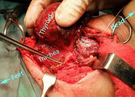 Thyroid surgery