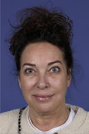 Posterior Müller Muscle-Conjunctival Resection as a First Step to Treat  Eyelid Ptosis: Clinical Results and Treatment Algorithm