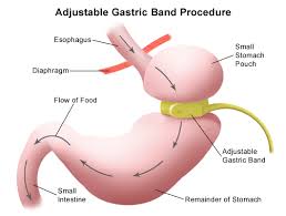 Pin On Dr Randeep Wadhawan Best Bariatric Surgeon In Delhi