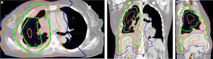 This is a form of highly targeted external beam radiation therapy, in which a machine called a linear accelerator treats the tumor. Radiation Therapy For Malignant Pleural Mesothelioma Sciencedirect