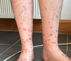 Image result for flea bites