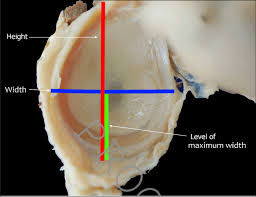 Click now and learn everything about its anatomy and function at kenhub! Measurement Of The Glenoid Fossa With The Glenoid Labrum Attached Download Scientific Diagram