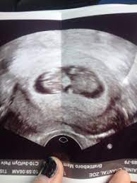 Fas Fetal Alcohol Syndrome Young Moms Forums What To Expect