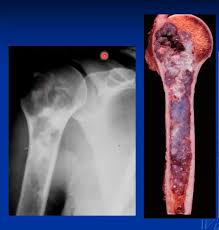 Image result for Chondrosarcoma