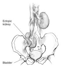 Rib cage, basketlike skeletal structure that forms the chest, or thorax, made up of the ribs and their the rib cage surrounds the lungs and the heart, serving as an important means of bony protection for. Ectopic Kidney Niddk