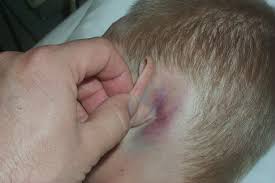 Battles Sign Is Bruising Over The Mastoid Bone Behind The Ear It Is Seen Several Days Following A Basilar Skull Fractu Emergency Nursing Nurse Medical Facts