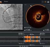Optical Coherence Tomography (OCT) Intravascular Imaging ...