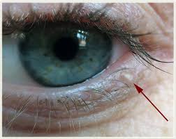 Image result for milium cyst on eyelid