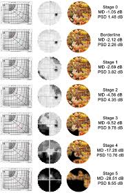 Image result for Visual Field Deficit