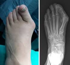 Bunion Surgery Orthoinfo Aaos Bunion Surgery Bunion Surgery