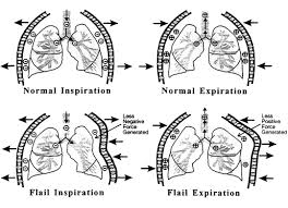 Image result for Flail Chest
