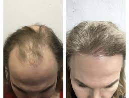 Factors affecting the cost include the extent of your hair loss and the quality of the clinic. Mens Hair Transplant Cost Harley Street Healthcarehair Transplant Clinic In London Manchester Birmingham Uk