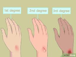 First, second and third degree skin burns. 3 Ways To Treat A Serious Burn Wikihow