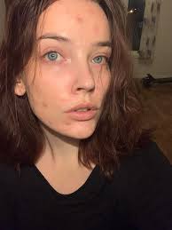 can any of you ladies help me out w how to lighten or get rid of acne scars  i absolutely hate my face i broke out so much when i was pregnant