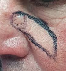 Image result for skin cancer on nose pimple