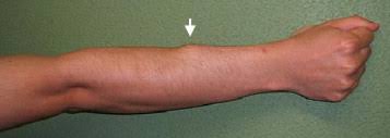 Picture of the achilles tendon. Snapping Wrist Caused By Tenosynovitis Of The Extensor Carpi Radialis Longus Tendon Subsequent To Subcutaneous Muscle Rupture In The Forearm Case Report Sciencedirect