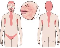 Home symptome gesicht ausschlag und geschwüre im gesicht. Seborrhoisches Ekzem Gesundheitsinformation De