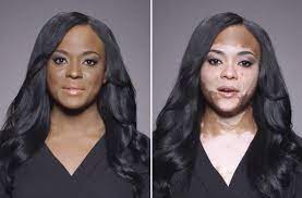 Vitiligo is classified into two different types and three subtypes. Dermablend S New Campaign Will Make You Feel Feelings Vitiligo Treatment Vitiligo What Is Vitiligo
