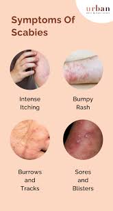 Image result for scabies symptoms