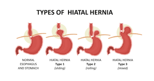 Hiatal hernia is a condition that produces one or more of the following symptoms: Do S And Don Ts After Hiatus Hernia Surgery Hiatus Repair Or Nissen Fundoplication Bestbariatricsurgeon Org