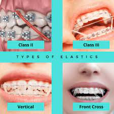How long does it take to get used to elastics? What Are Interarch Rubber Bands