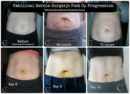 What To Expect During Umbilical Hernia Surgery Recovery Relentless Forward Commotion In 2020 Umbilical Hernia Hernia Repair Umbilical Hernia Repair