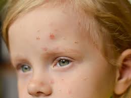 Image result for Scarlet Fever