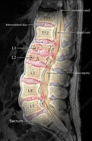 I was diagnosed with a l1 compression fracture (anterior is compressed by 37%), was hospitalized for a week, and had to wear a back brace. Lumbar Compression Fracture Illustration Stock Image C027 6314 Science Photo Library