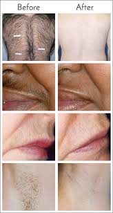 Want even more options for facial hair removal or more information on these remedies? Laser Hair Removal In Jacksonville At Obi Plastic Surgery Center