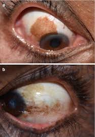 Image result for melanosis sclera