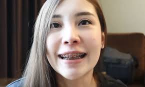 Chicas Con Frenos」おしゃれまとめの人気アイデア｜Pinterest｜Jacob Acuña