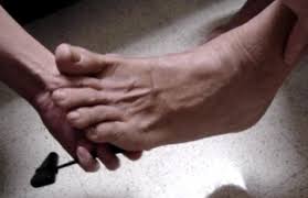 Image result for Babinski Reflex