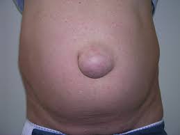 Clinical photograph of a prominent umbilical hernia on a patient's abdomen